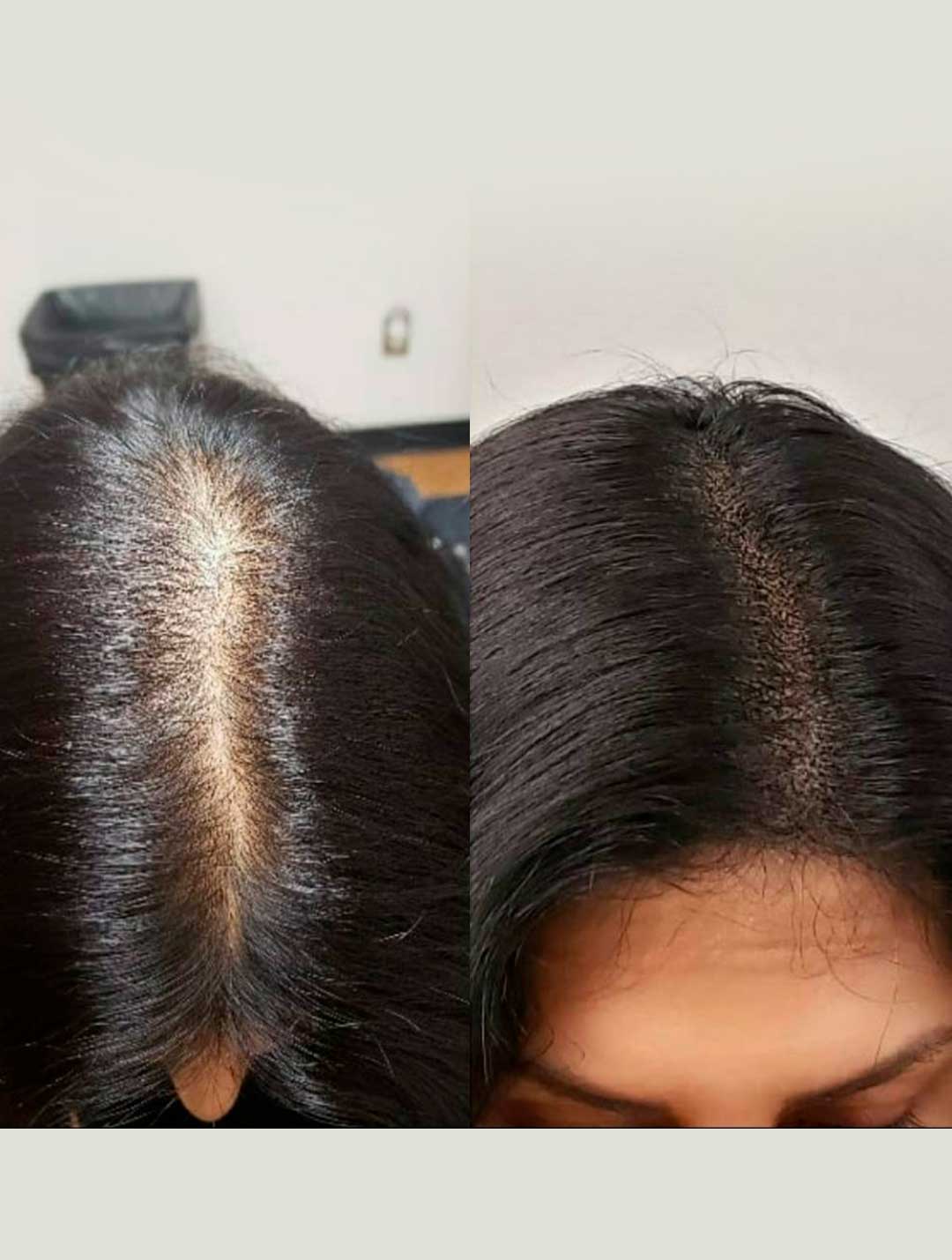 Scalp-Micropigmentation-(SMP)