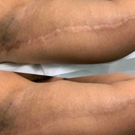 Scar & Stretch Mark Restoration Training