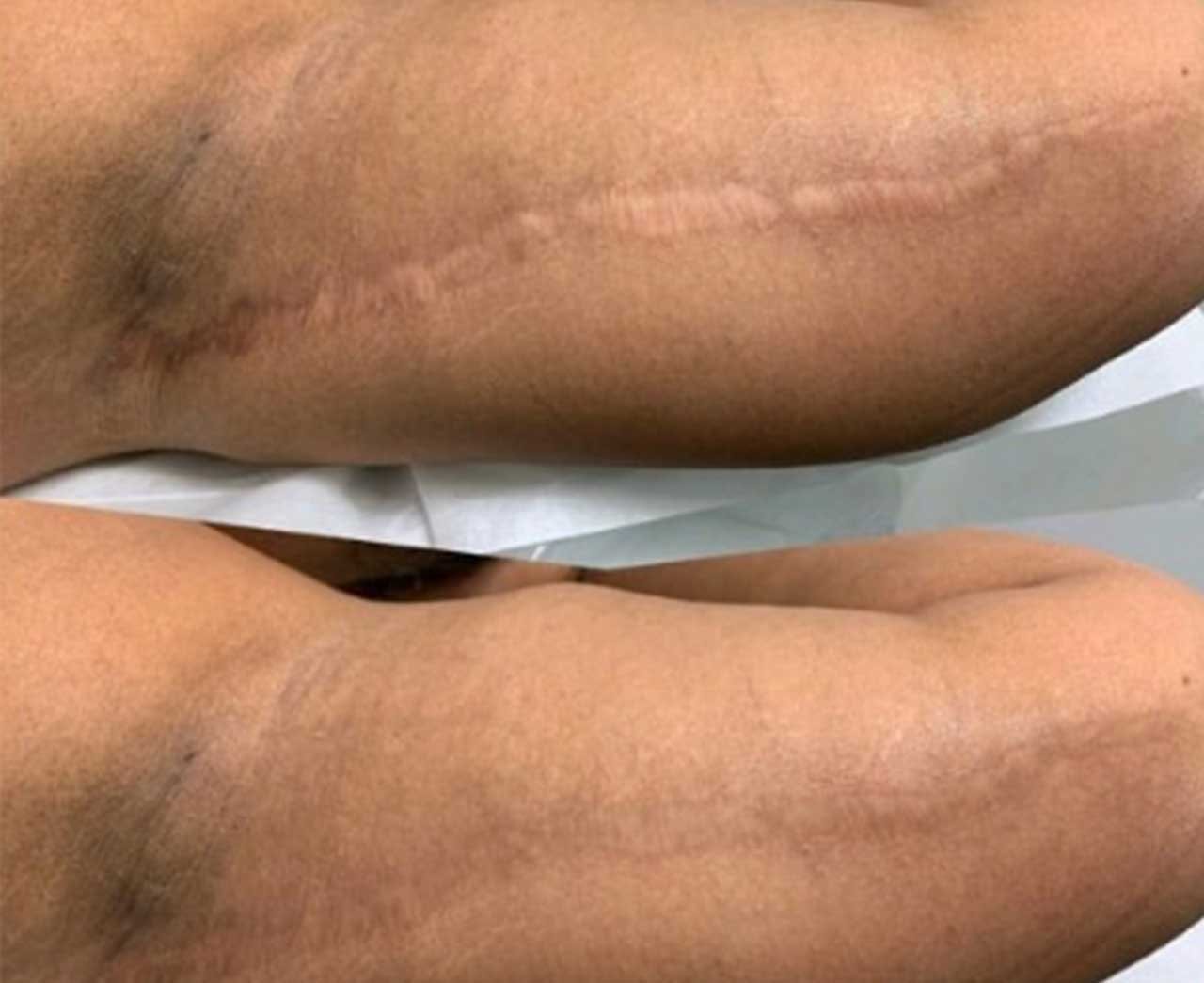 Scar & Stretch Mark Restoration Training